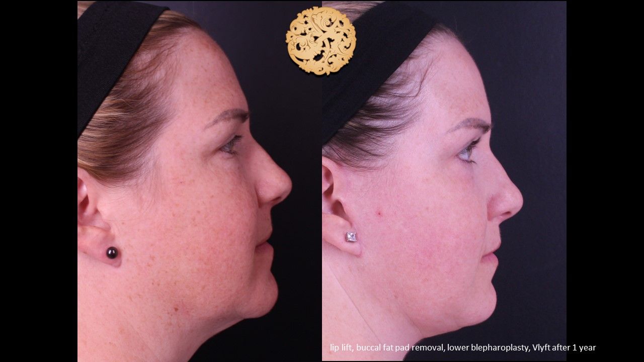 Blepharoplasty Before & After