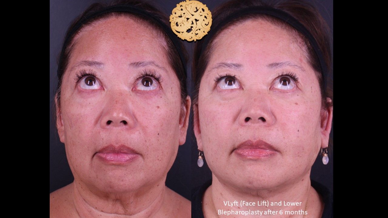 Blepharoplasty Before & After