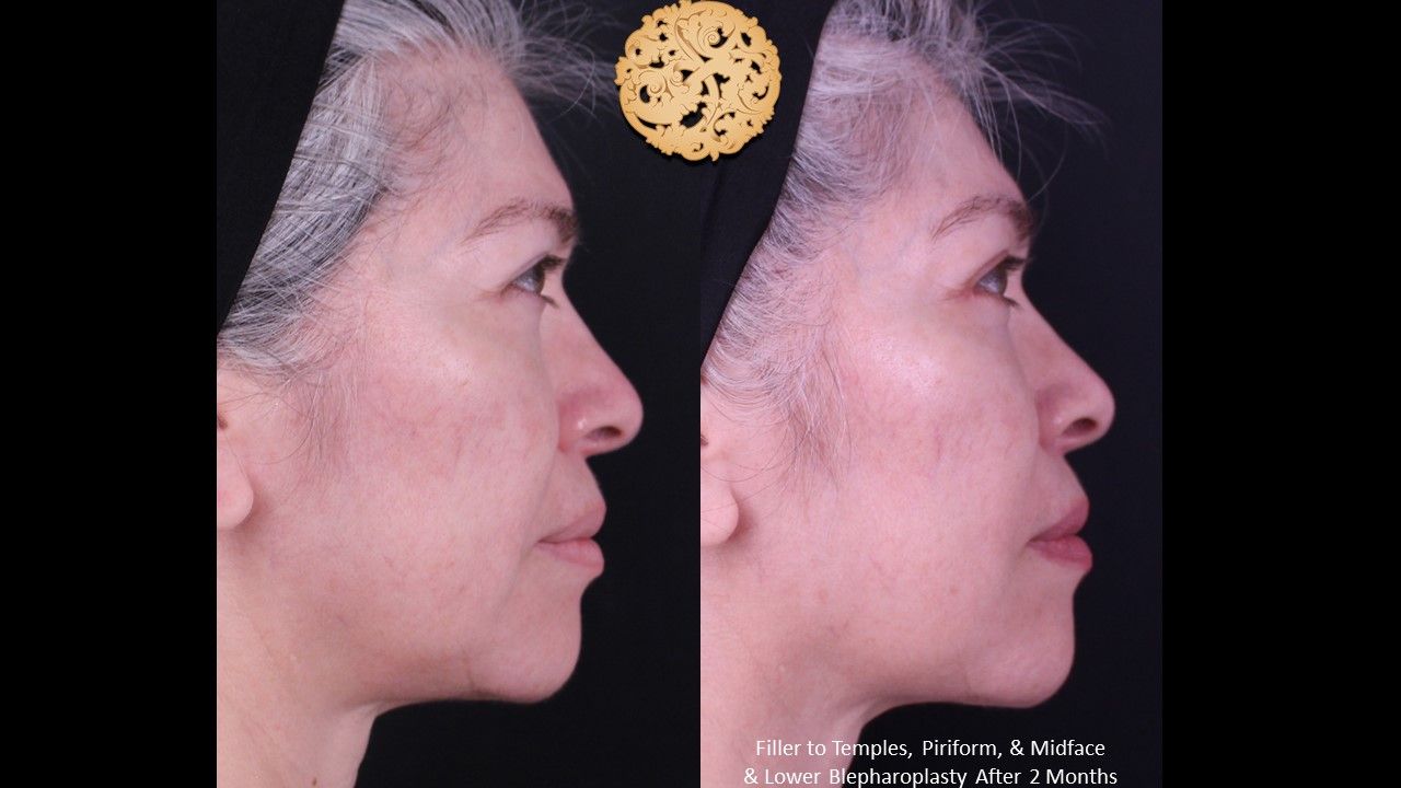 Blepharoplasty Before & After