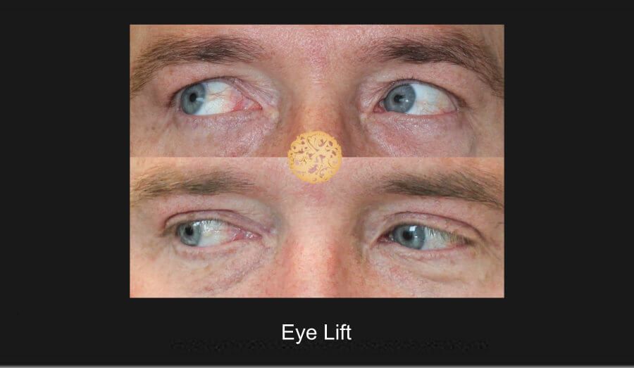 Blepharoplasty Before & After