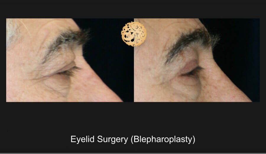 Blepharoplasty Before & After