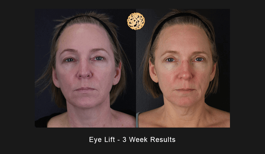 Blepharoplasty Before & After