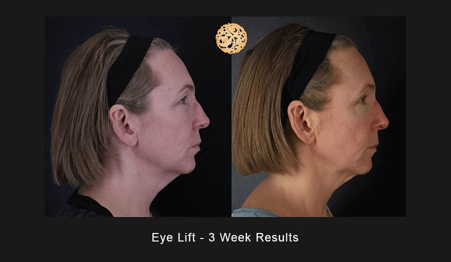 Blepharoplasty Before & After