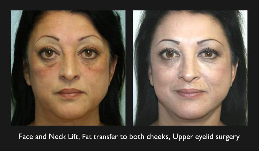 Blepharoplasty Before & After