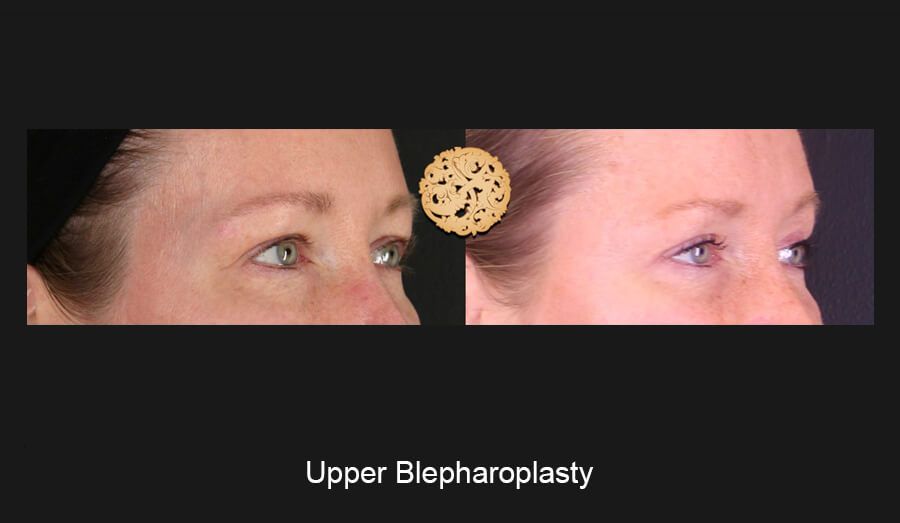 Blepharoplasty Before & After