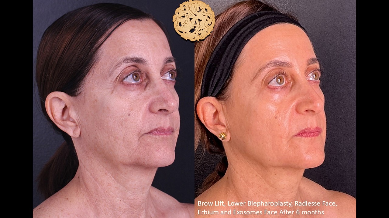 Blepharoplasty Before & After