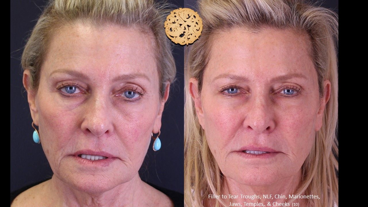 Biolyft Before & After