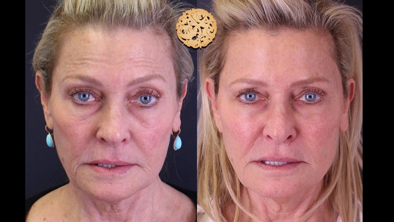 Biolyft Before & After