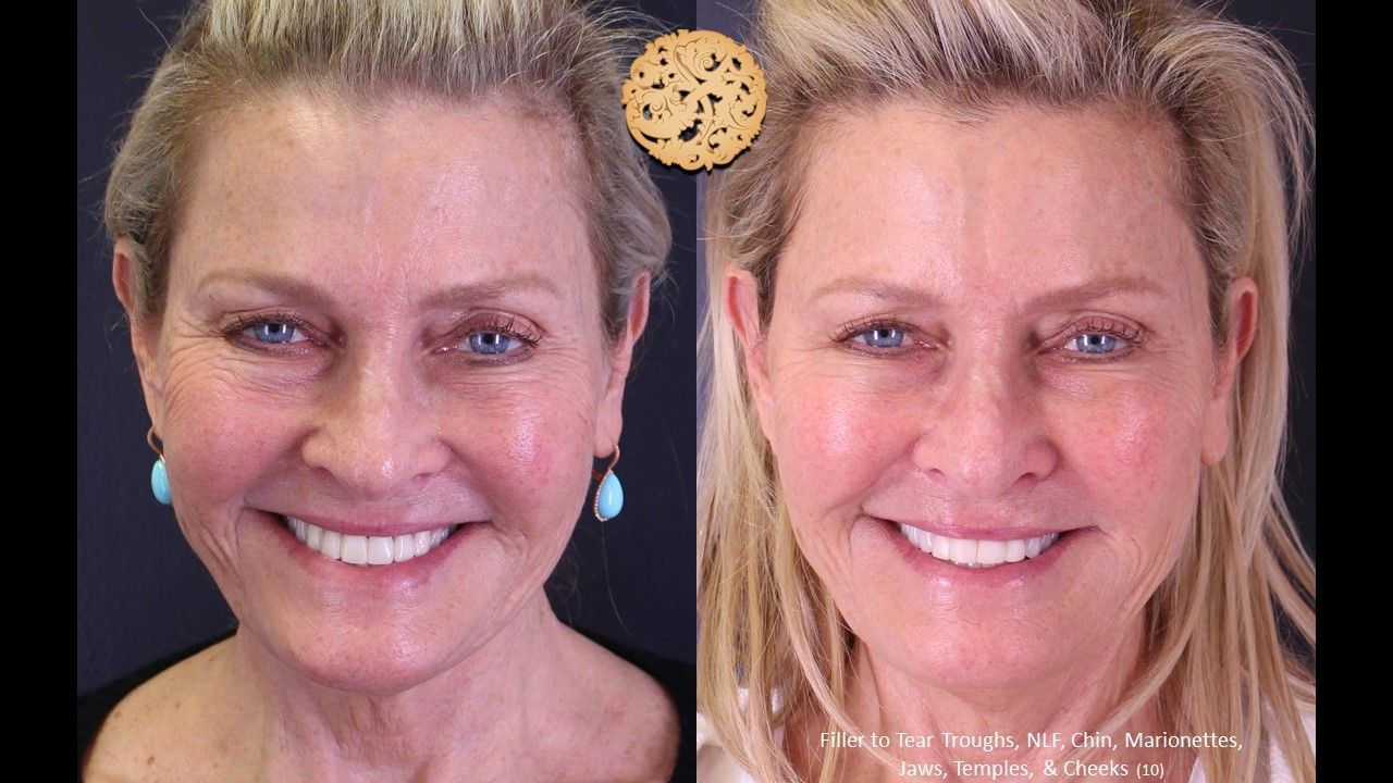 Biolyft Before & After