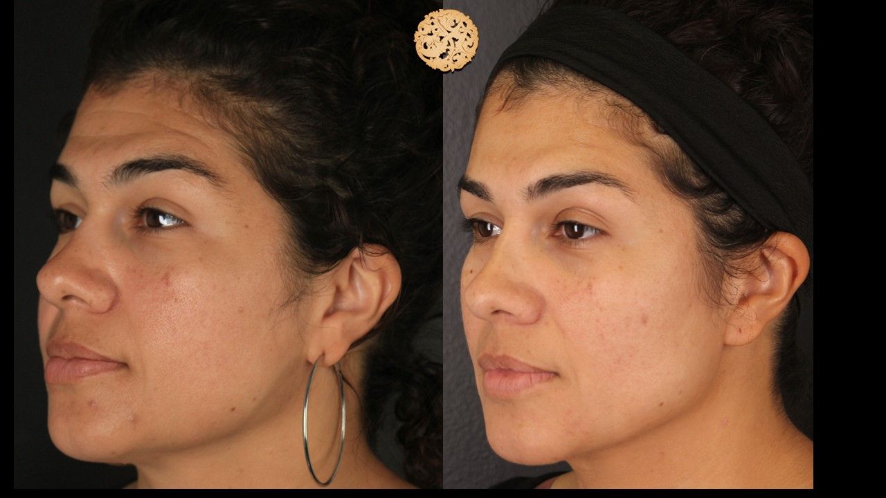 Microneedling Before & After