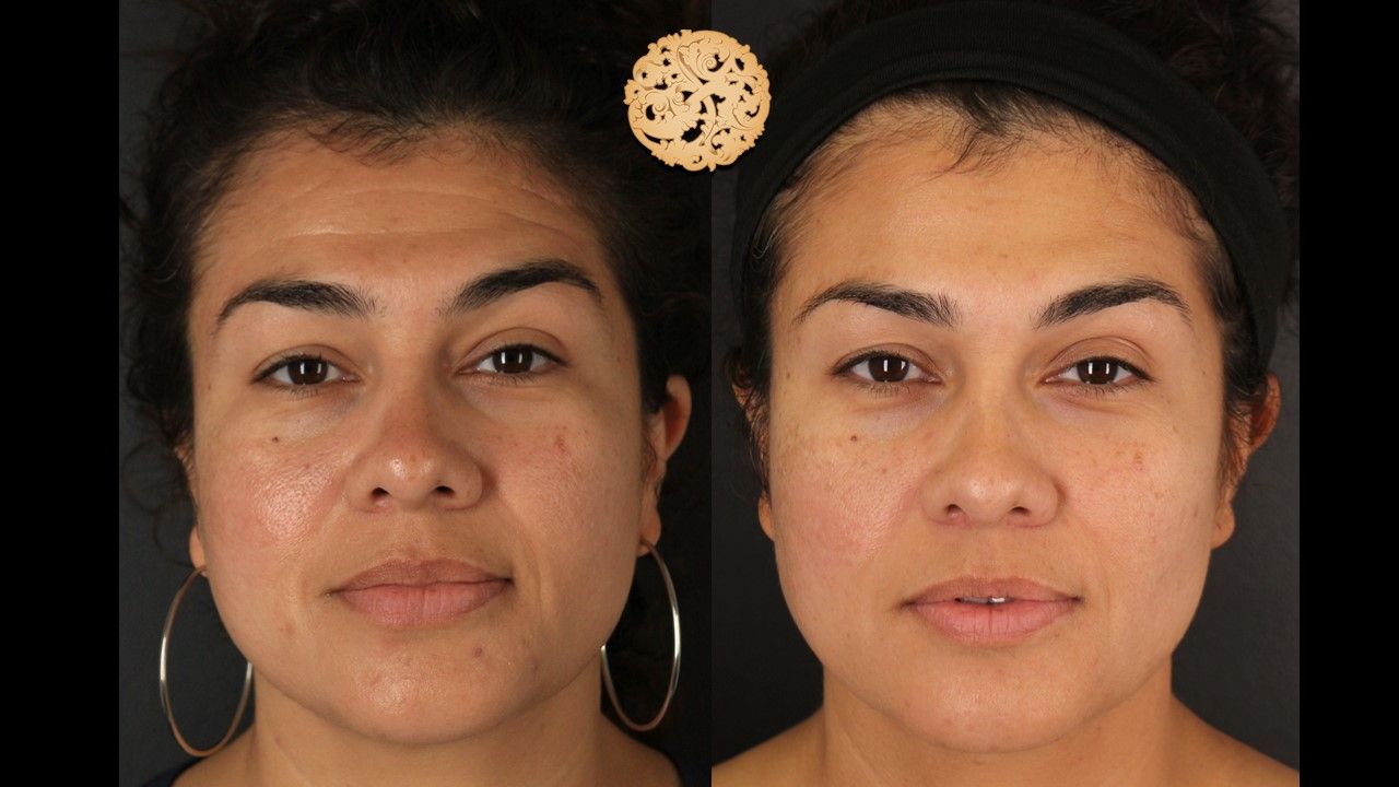 Microneedling Before & After