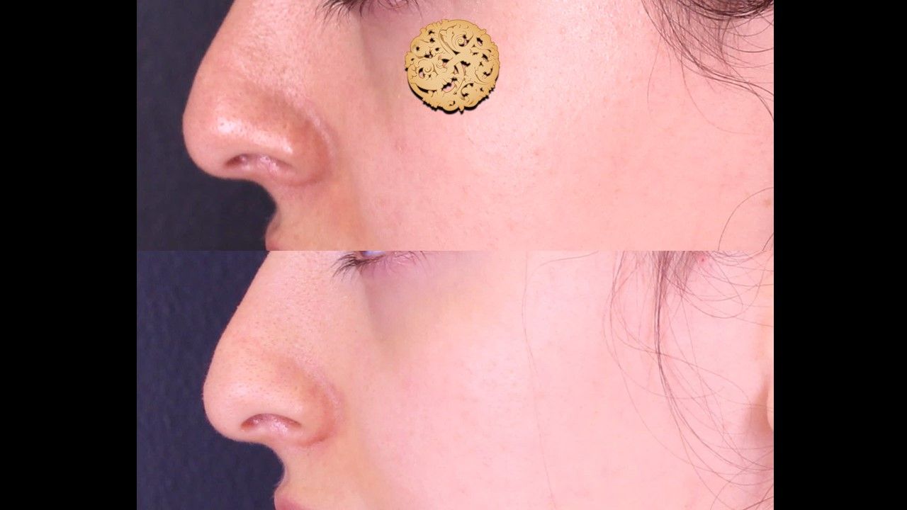 Microneedling Before & After