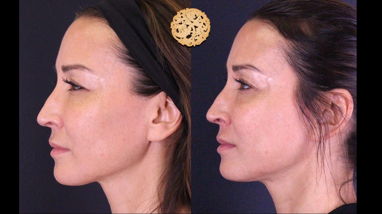 Microneedling Before & After