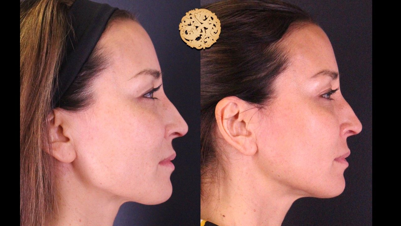 Microneedling Before & After