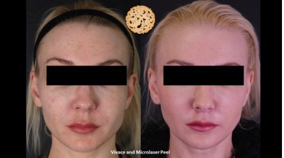 Microneedling Before & After