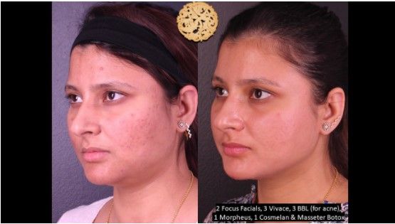 Microneedling Before & After