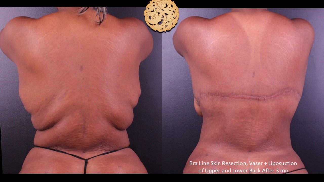 Upper Back Lift Before & After