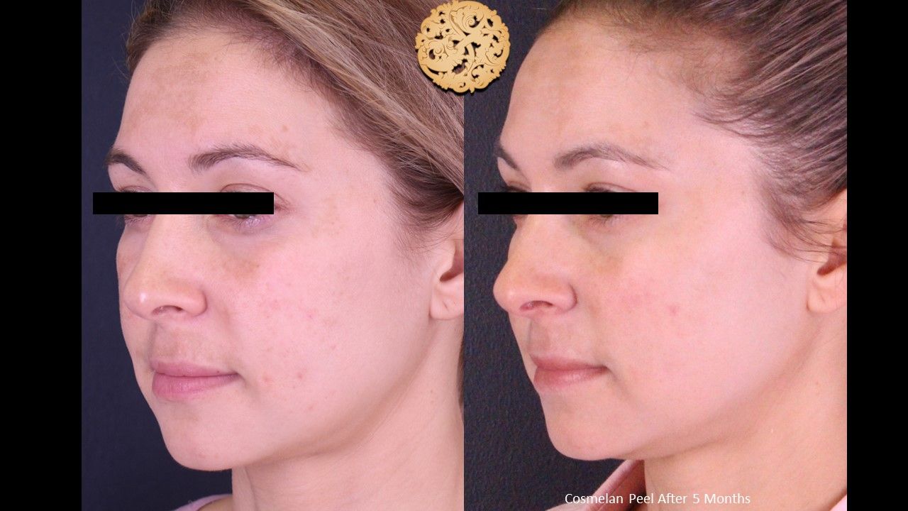 Chemical Peel Before & After