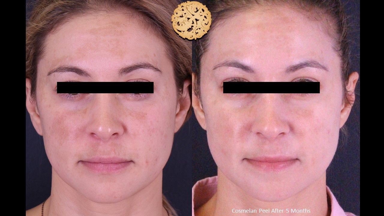 Chemical Peel Before & After