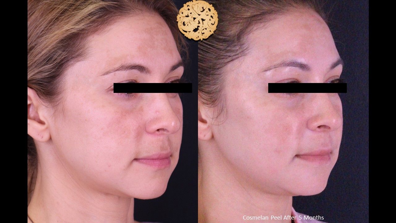 Chemical Peel Before & After