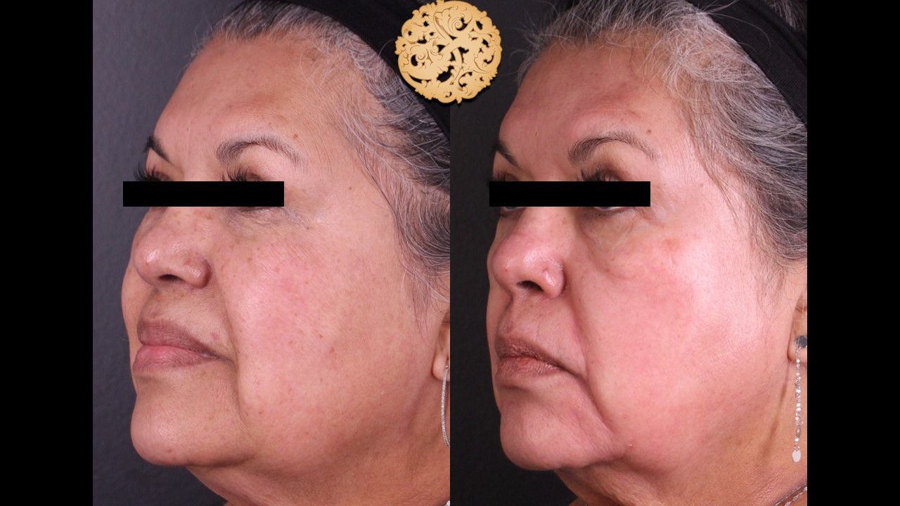 Chemical Peel Before & After