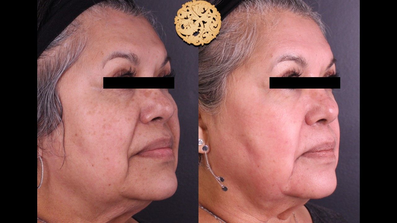 Chemical Peel Before & After