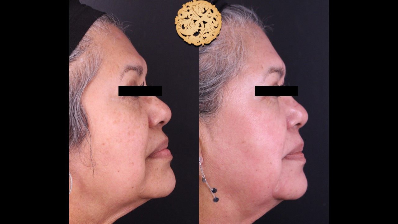 Chemical Peel Before & After