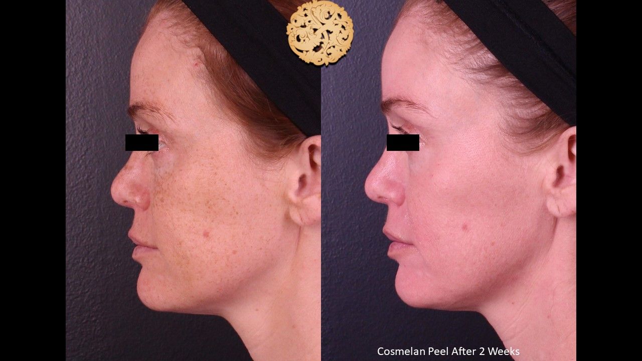 Chemical Peel Before & After