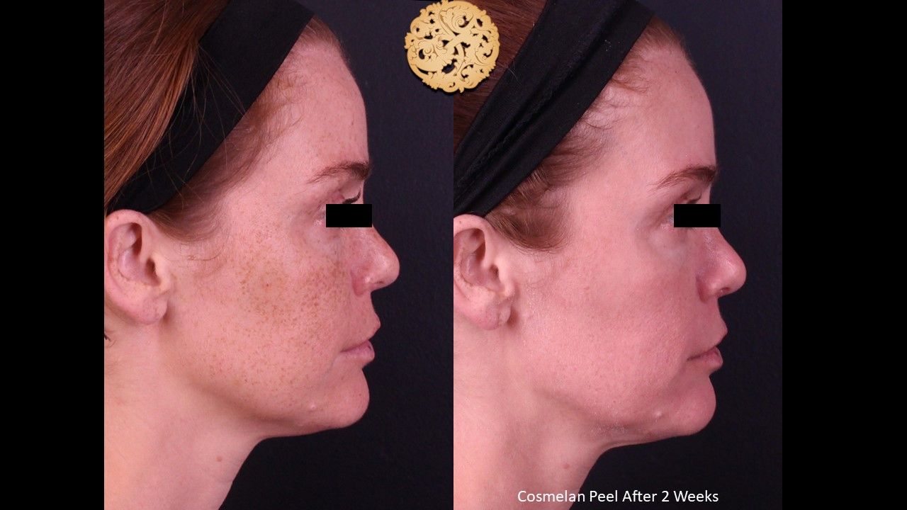 Chemical Peel Before & After