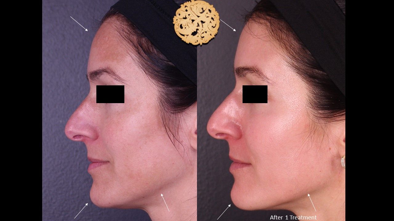 Chemical Peel Before & After