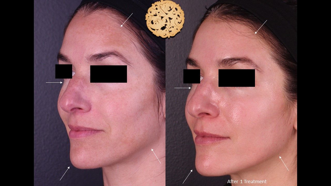 Chemical Peel Before & After