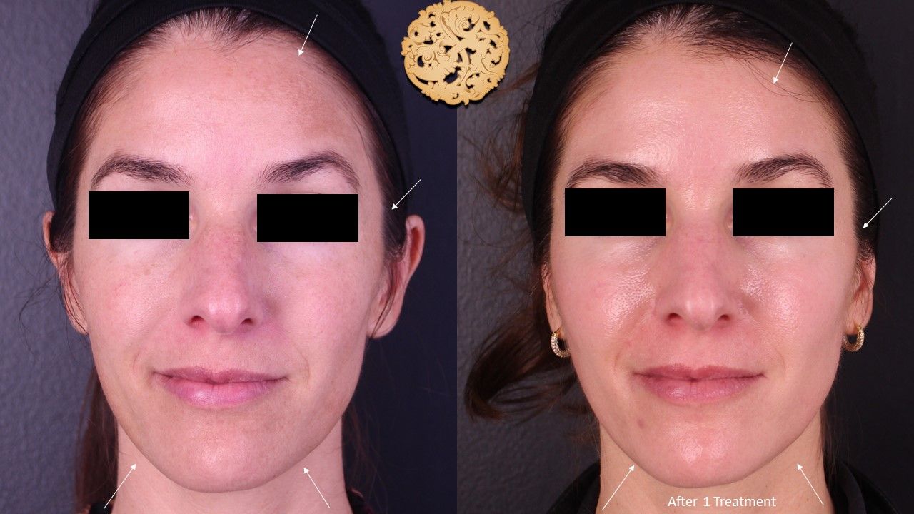 Chemical Peel Before & After