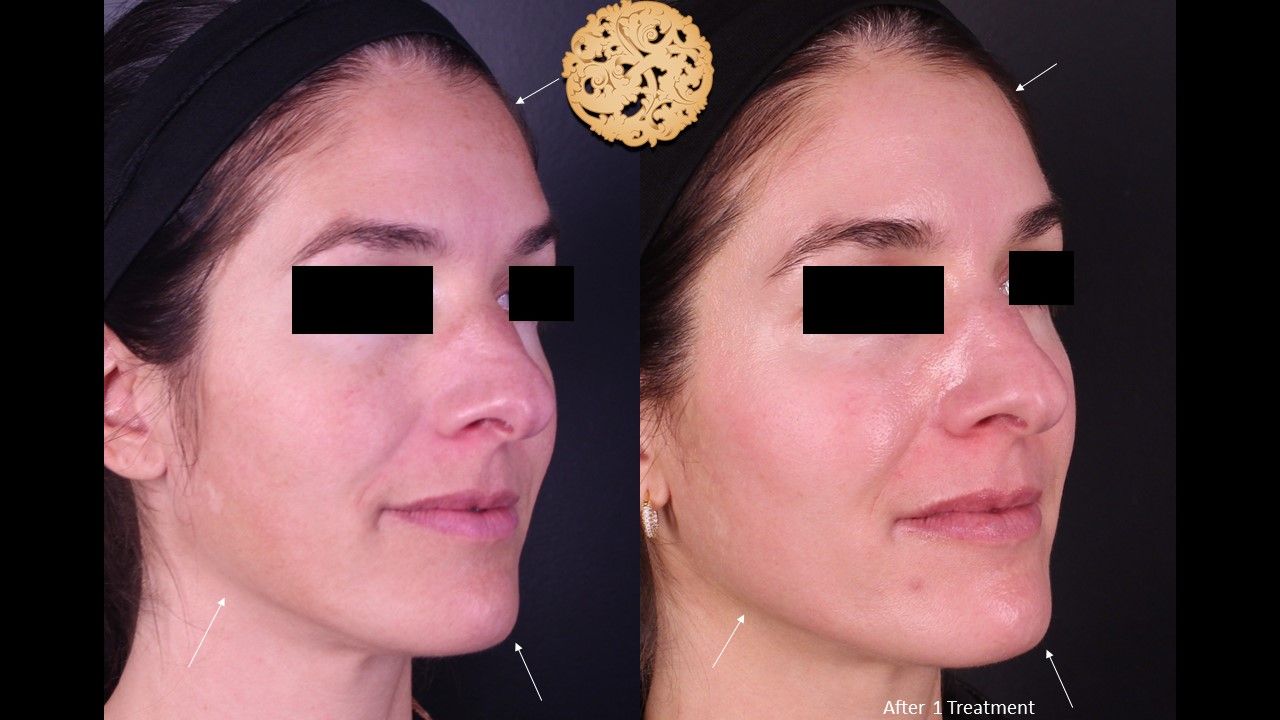 Chemical Peel Before & After