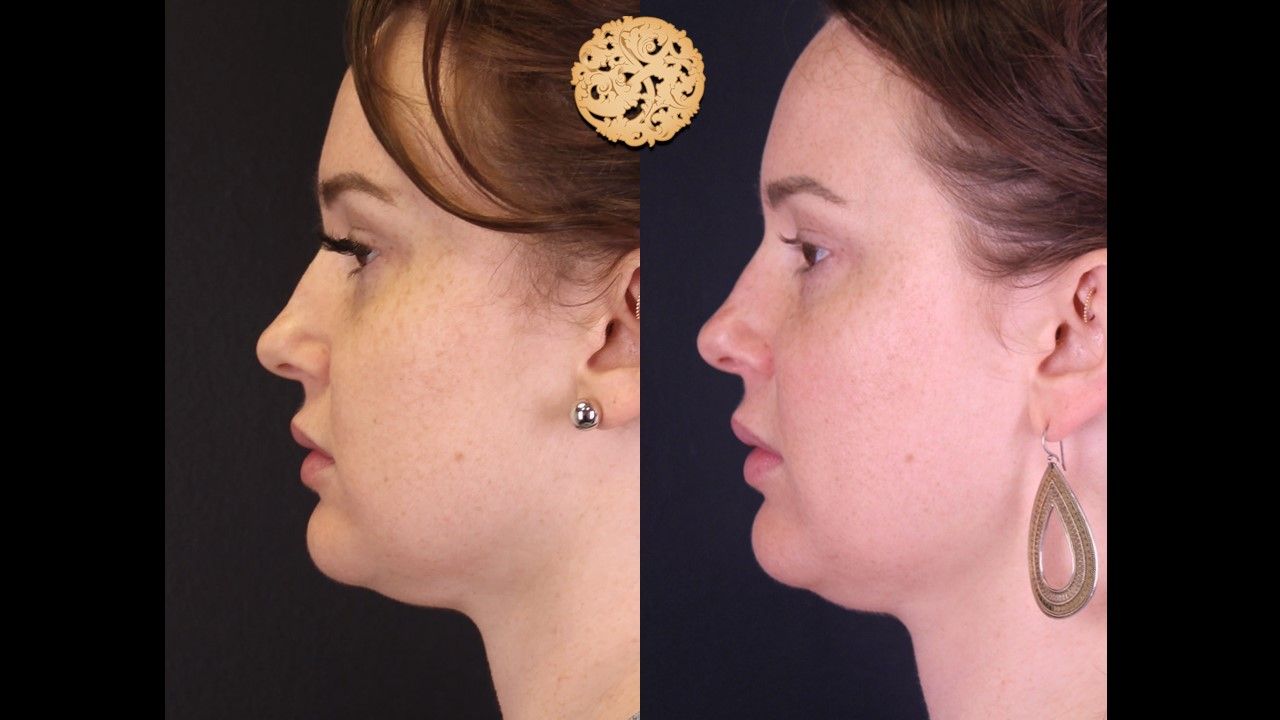 Chemical Peel Before & After