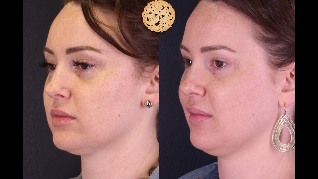 Chemical Peel Before & After