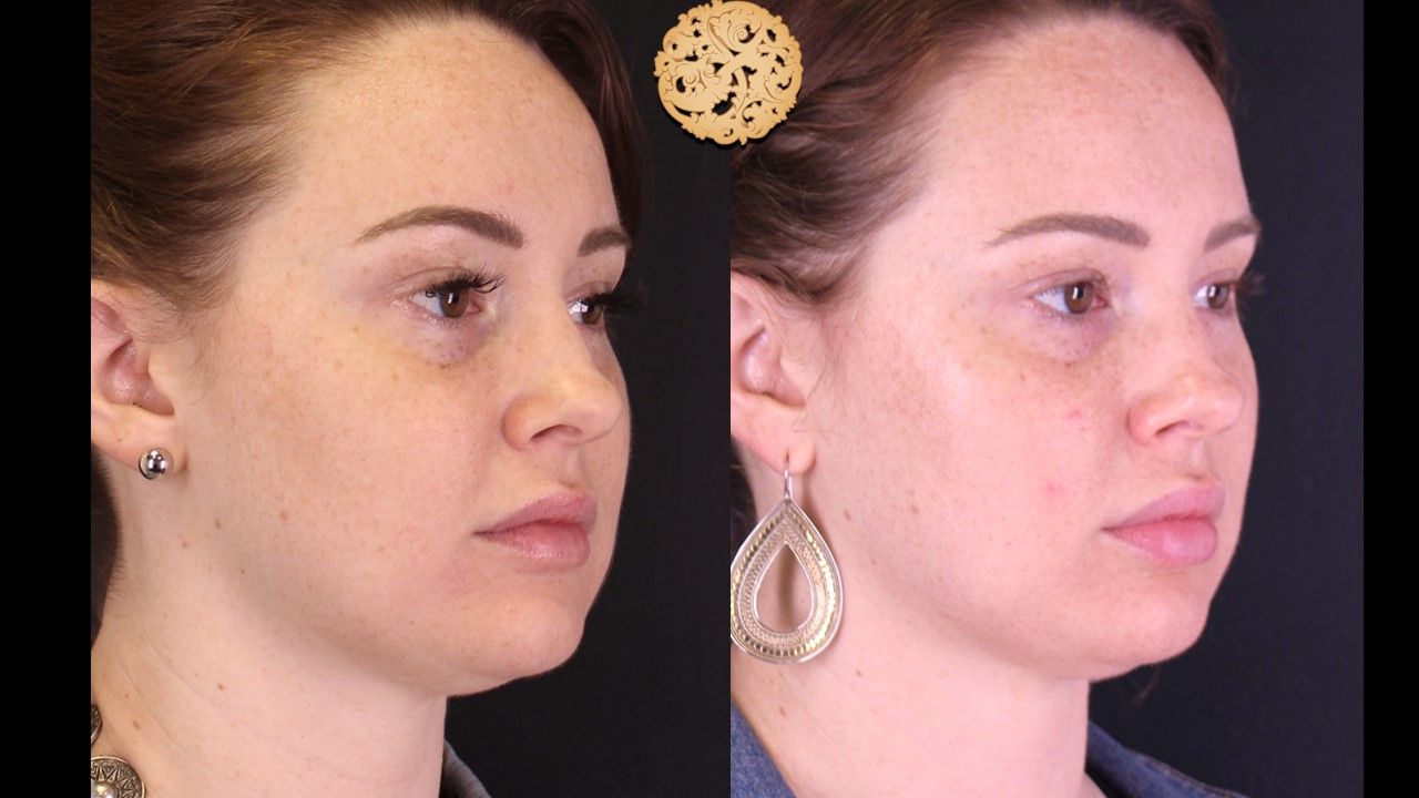 Chemical Peel Before & After