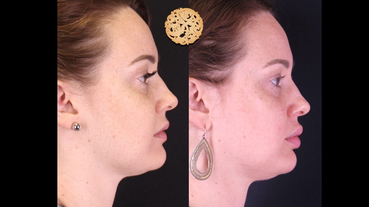 Chemical Peel Before & After