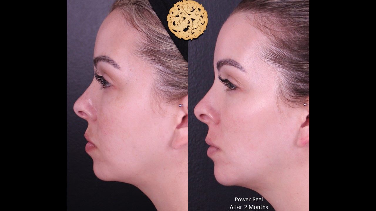 Chemical Peel Before & After