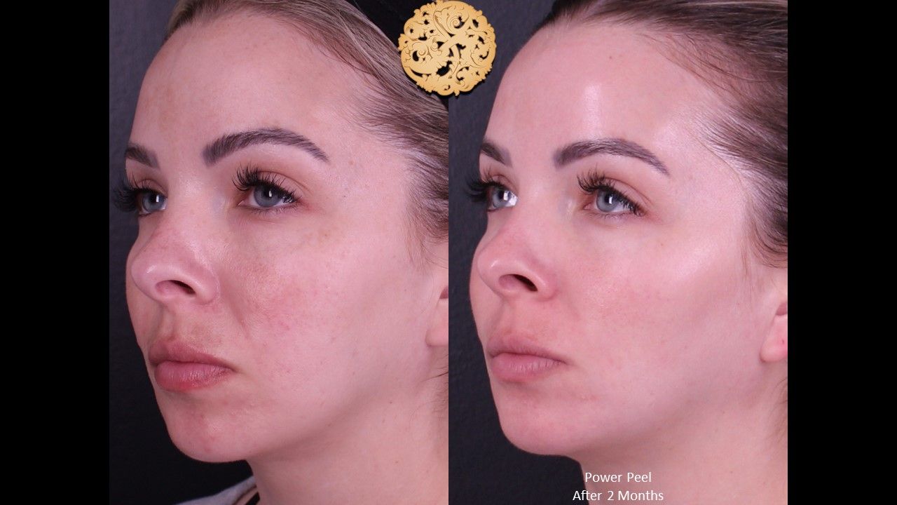 Chemical Peel Before & After