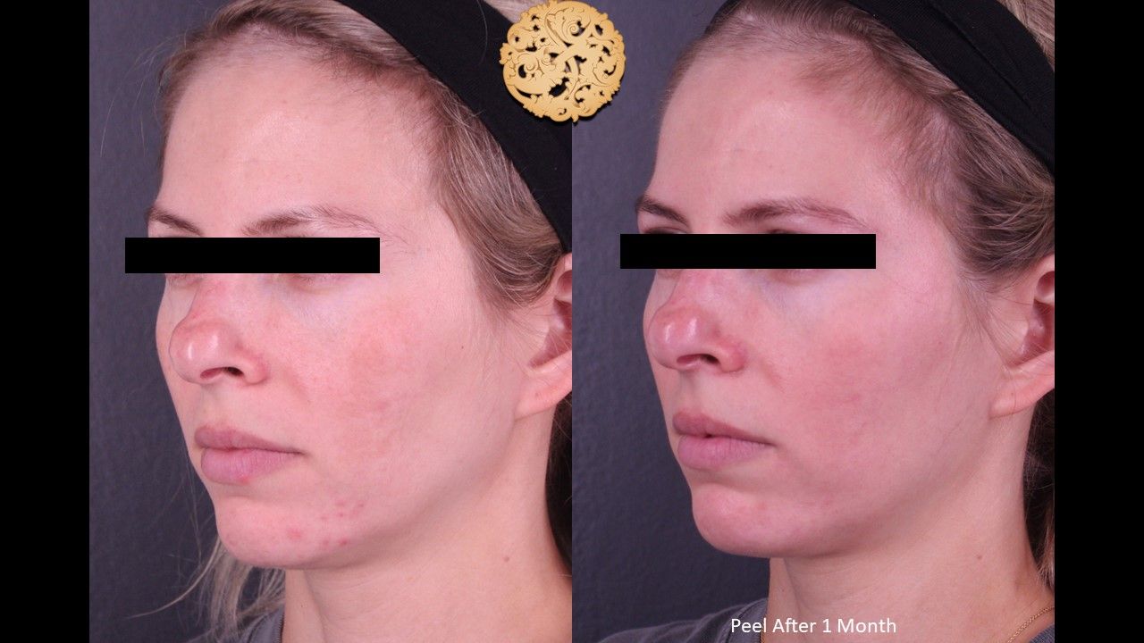 Chemical Peel Before & After