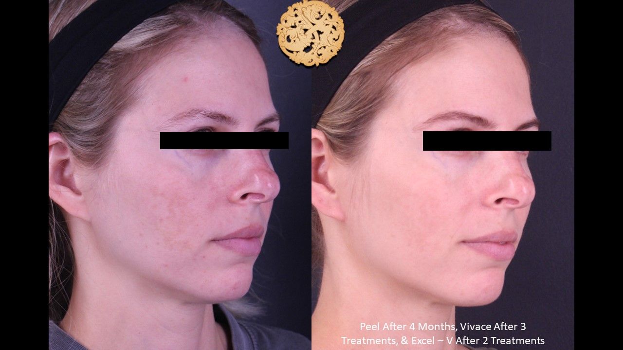 Chemical Peel Before & After