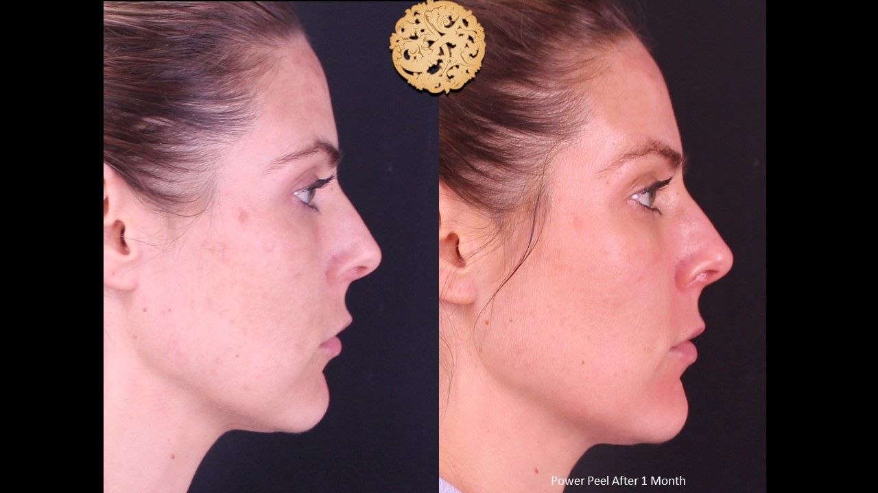Chemical Peel Before & After
