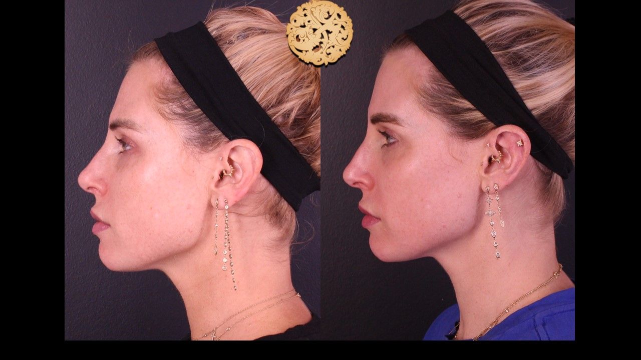 Chemical Peel Before & After
