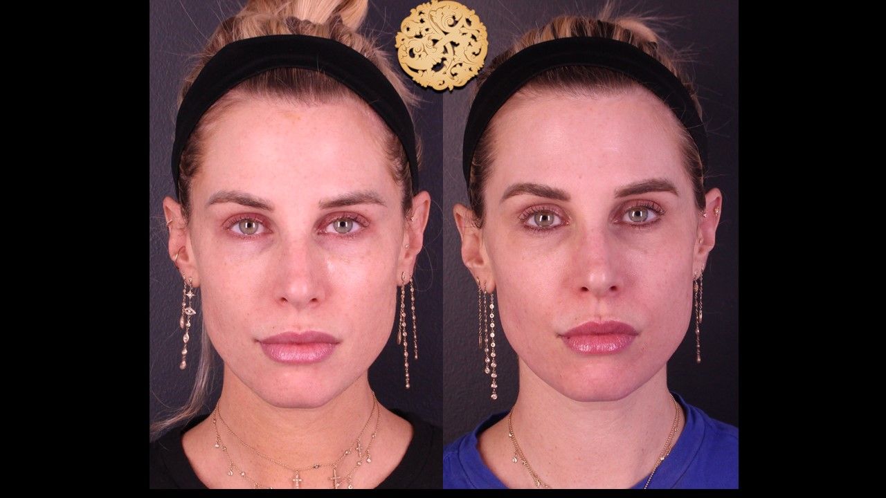 Chemical Peel Before & After