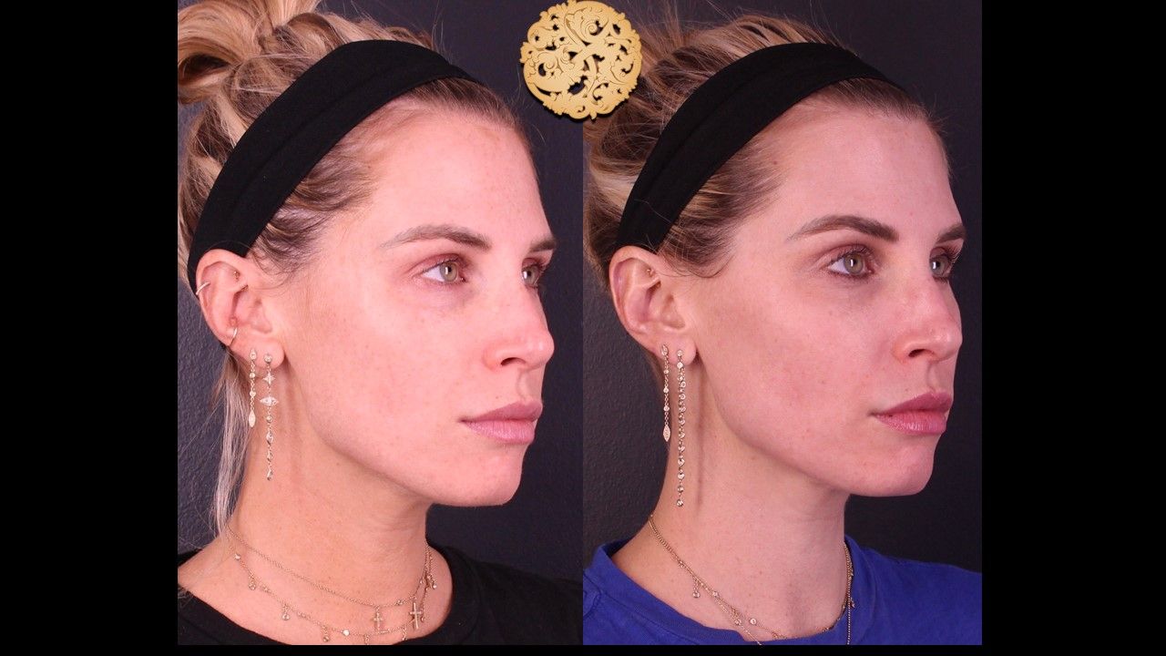 Chemical Peel Before & After