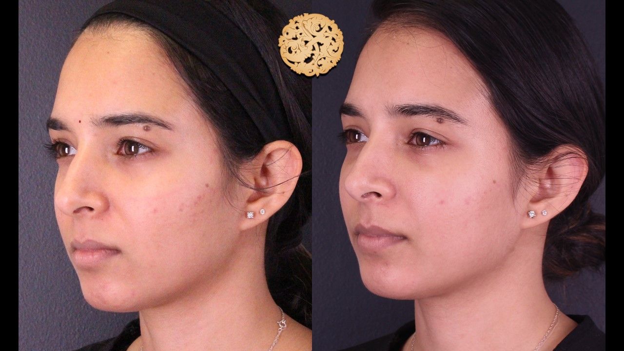 Chemical Peel Before & After