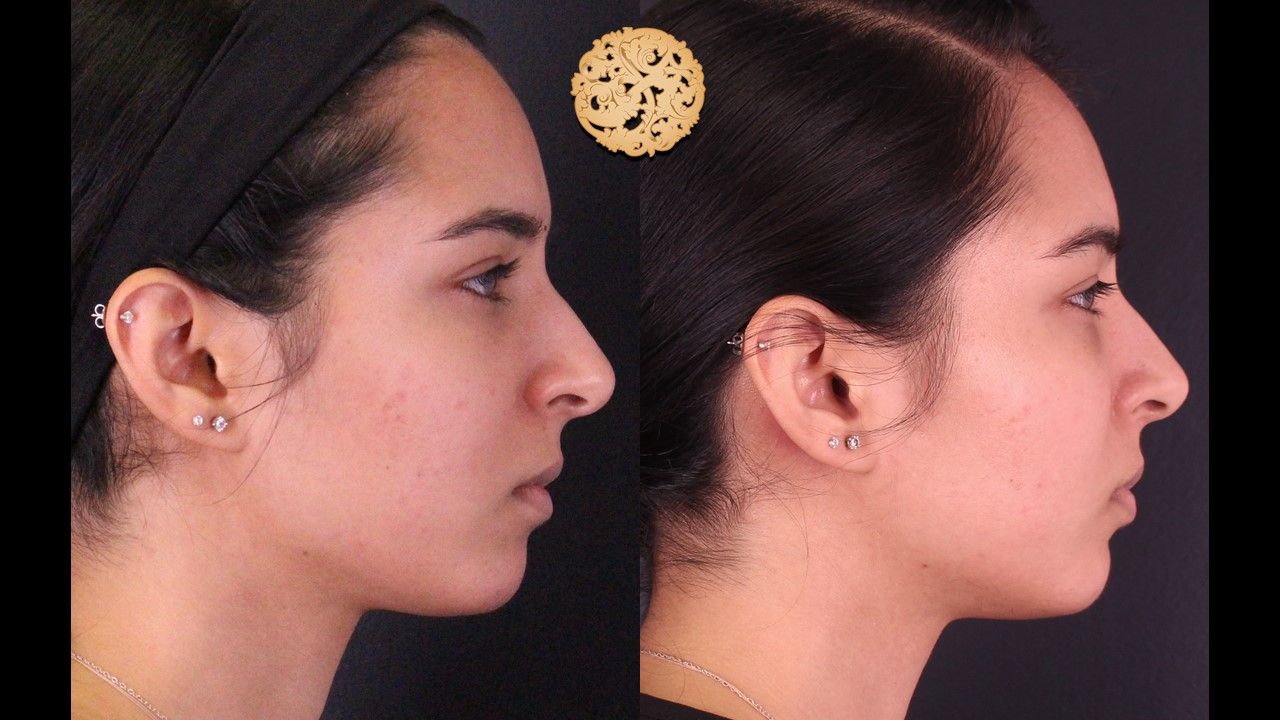 Chemical Peel Before & After