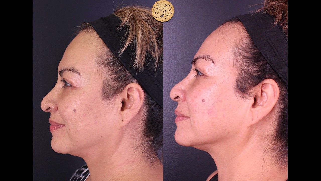 Chemical Peel Before & After