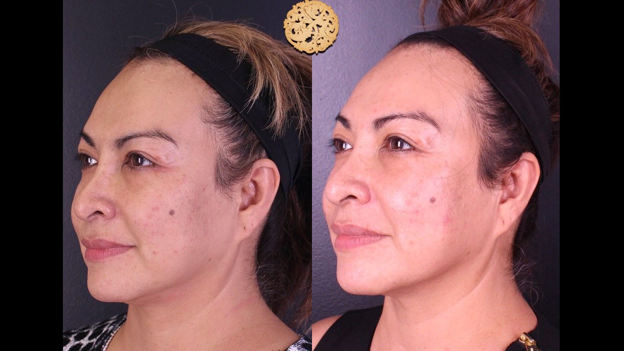 Chemical Peel Before & After