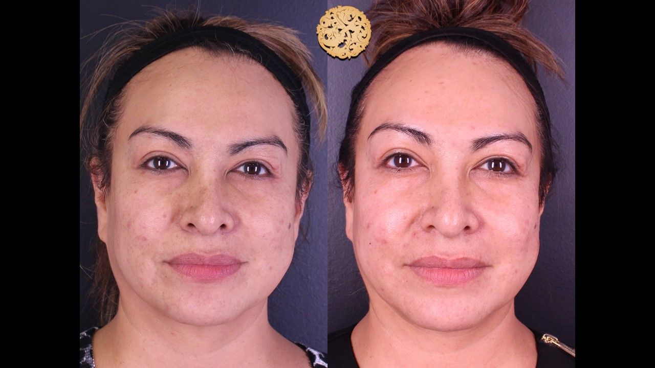 Chemical Peel Before & After